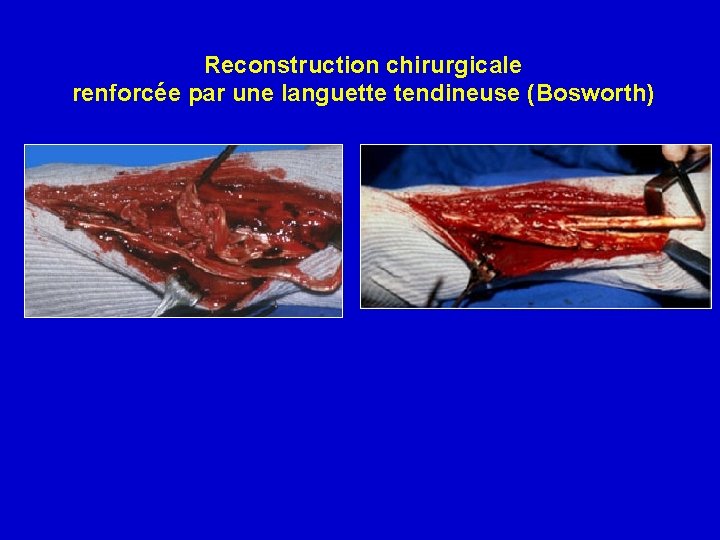 Reconstruction chirurgicale renforcée par une languette tendineuse (Bosworth) 