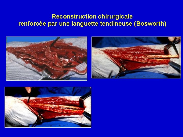 Reconstruction chirurgicale renforcée par une languette tendineuse (Bosworth) 