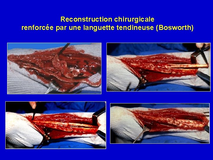 Reconstruction chirurgicale renforcée par une languette tendineuse (Bosworth) 