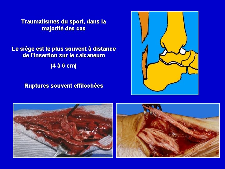 Traumatismes du sport, dans la majorité des cas Le siège est le plus souvent
