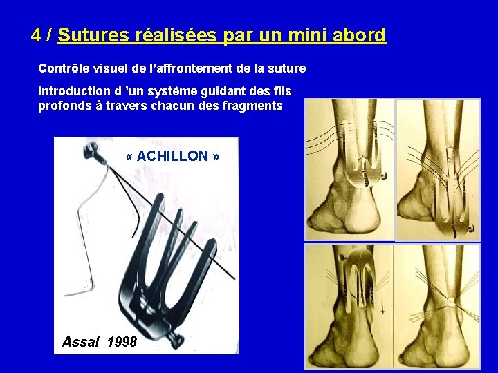  4 / Sutures réalisées par un mini abord Contrôle visuel de l’affrontement de