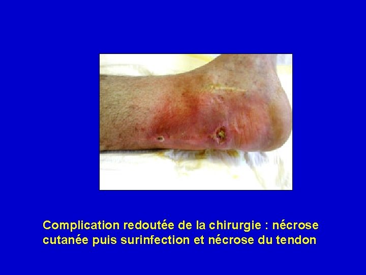 Complication redoutée de la chirurgie : nécrose cutanée puis surinfection et nécrose du tendon