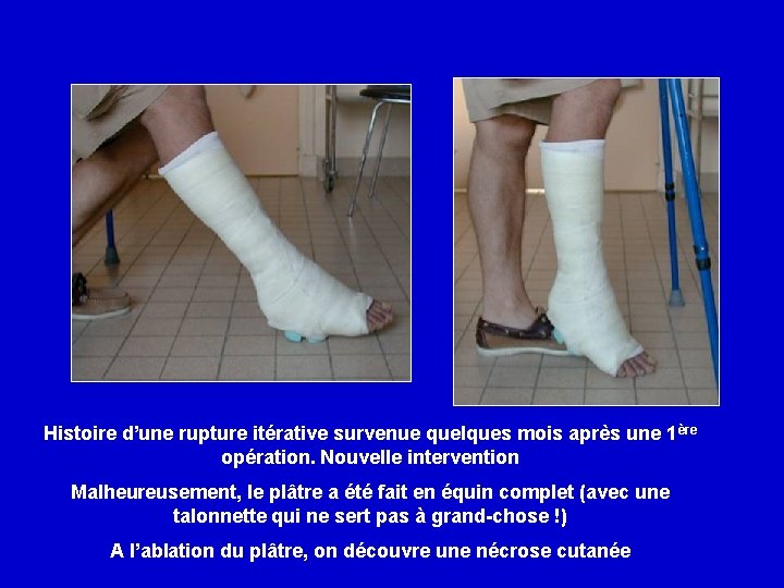 Histoire d’une rupture itérative survenue quelques mois après une 1 ère opération. Nouvelle intervention
