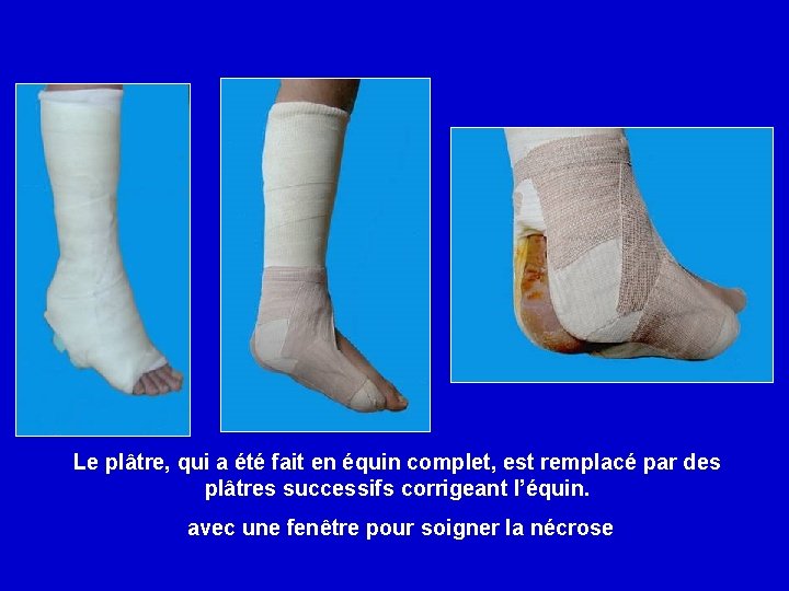 Le plâtre, qui a été fait en équin complet, est remplacé par des plâtres