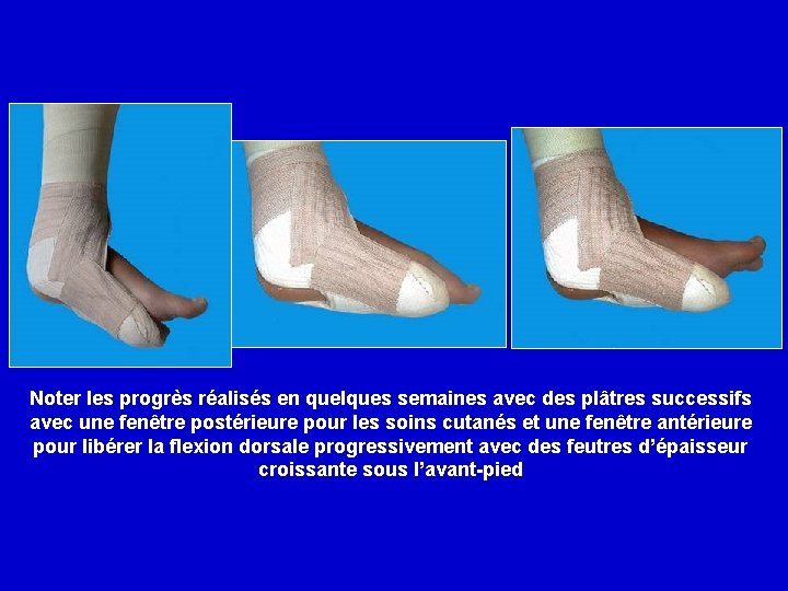 Noter les progrès réalisés en quelques semaines avec des plâtres successifs avec une fenêtre