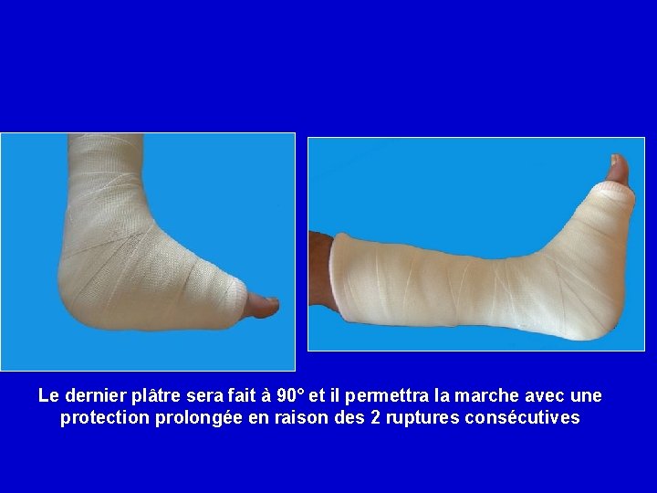 Le dernier plâtre sera fait à 90° et il permettra la marche avec une