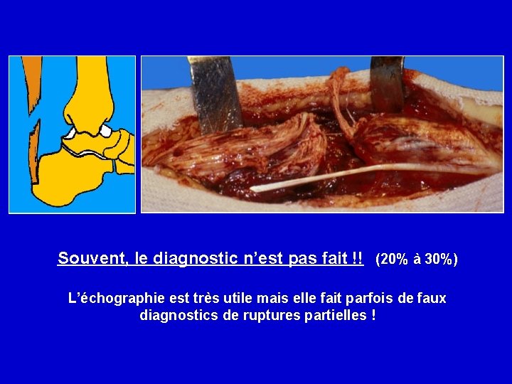 Souvent, le diagnostic n’est pas fait !! (20% à 30%) L’échographie est très utile