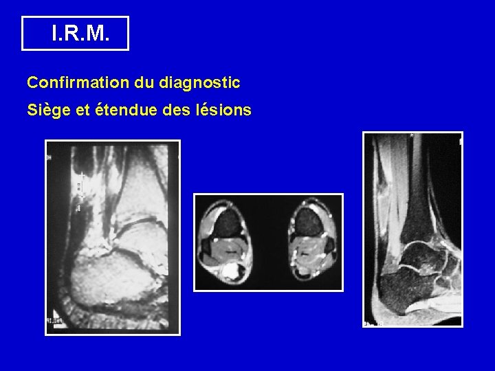  I. R. M. Confirmation du diagnostic Siège et étendue des lésions 