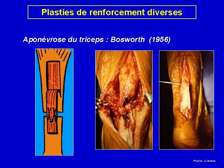 Plasties de renforcement diverses Aponévrose du triceps : Bosworth (1956) Photos JL Besse 