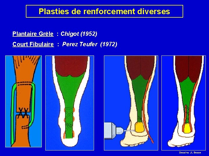 Plasties de renforcement diverses Plantaire Grêle : Chigot (1952) Court Fibulaire : Perez Teufer