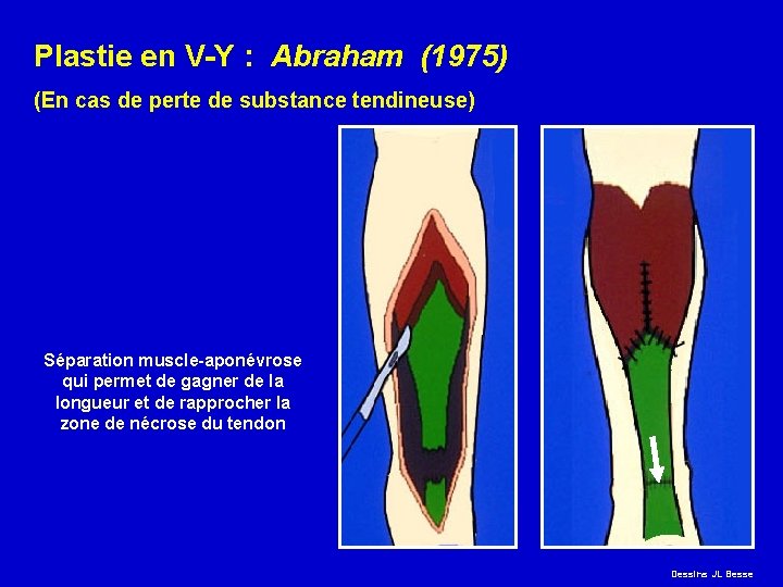Plastie en V-Y : Abraham (1975) (En cas de perte de substance tendineuse) Séparation