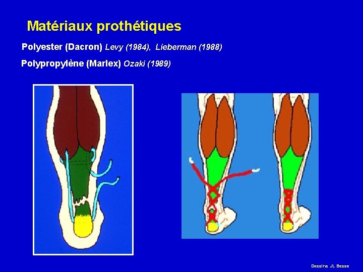  Matériaux prothétiques Polyester (Dacron) Levy (1984), Lieberman (1988) Polypropylène (Marlex) Ozaki (1989) Dessins