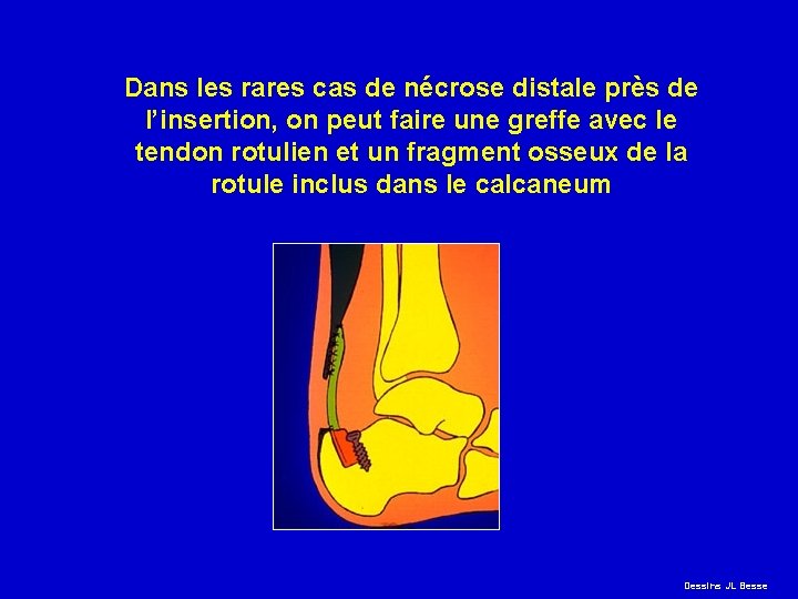 Dans les rares cas de nécrose distale près de l’insertion, on peut faire une