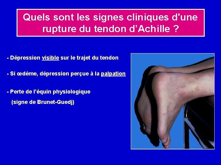 Quels sont les signes cliniques d'une rupture du tendon d’Achille ? - Dépression visible