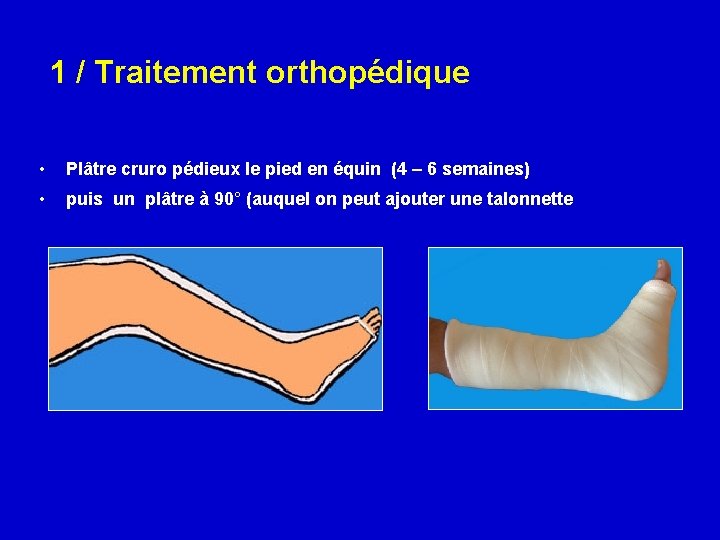 1 / Traitement orthopédique • Plâtre cruro pédieux le pied en équin (4 –