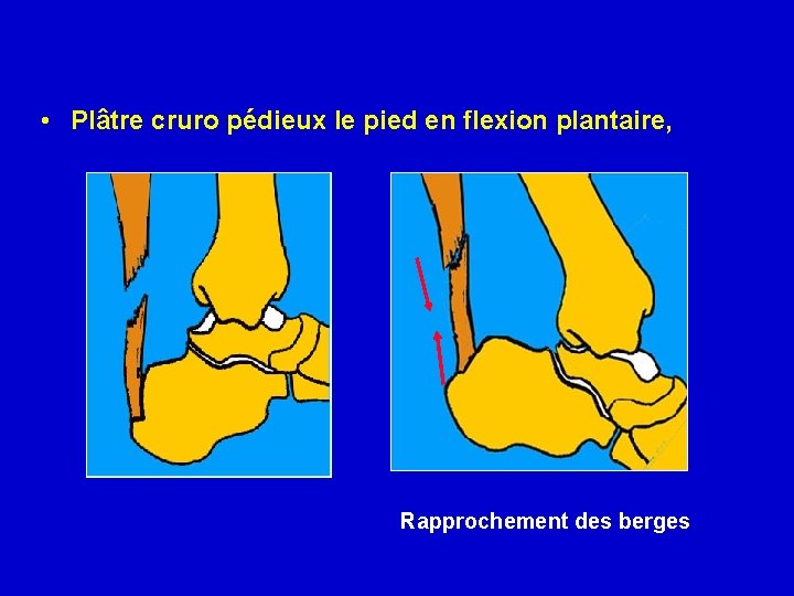  • Plâtre cruro pédieux le pied en flexion plantaire, Rapprochement des berges 