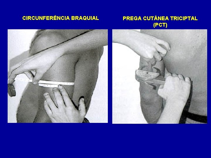 CIRCUNFERÊNCIA BRAQUIAL PREGA CUT NEA TRICIPTAL (PCT) 