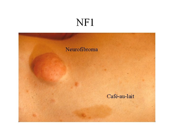 NF 1 Neurofibroma Café-au-lait 