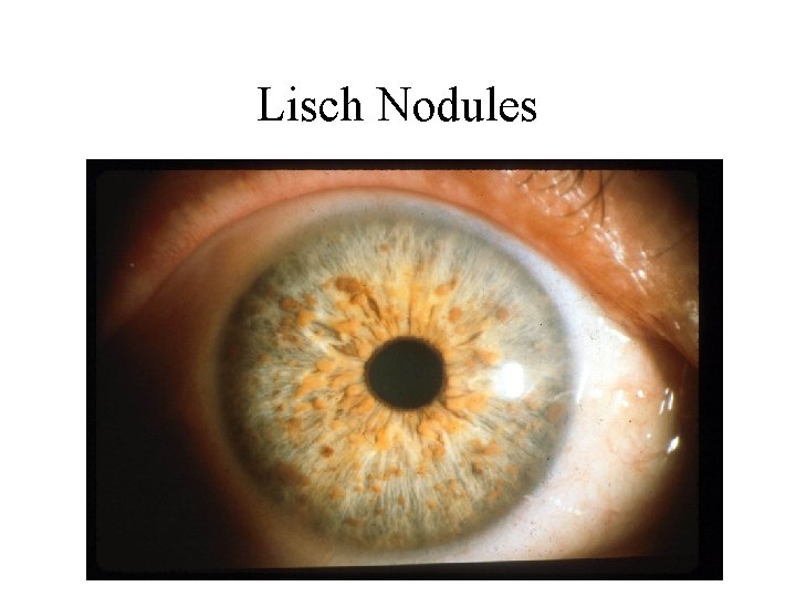 Lisch Nodules 