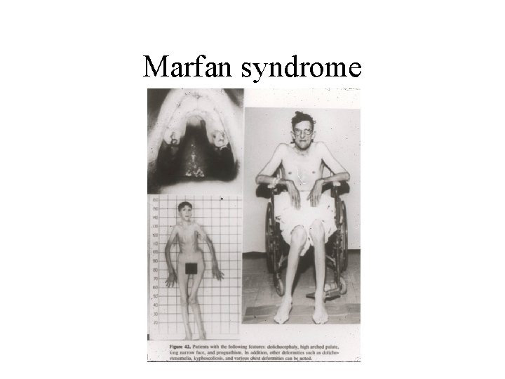Marfan syndrome 