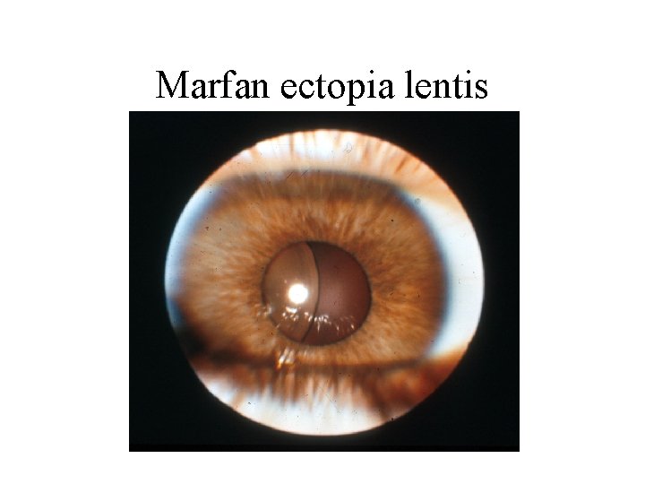 Marfan ectopia lentis 