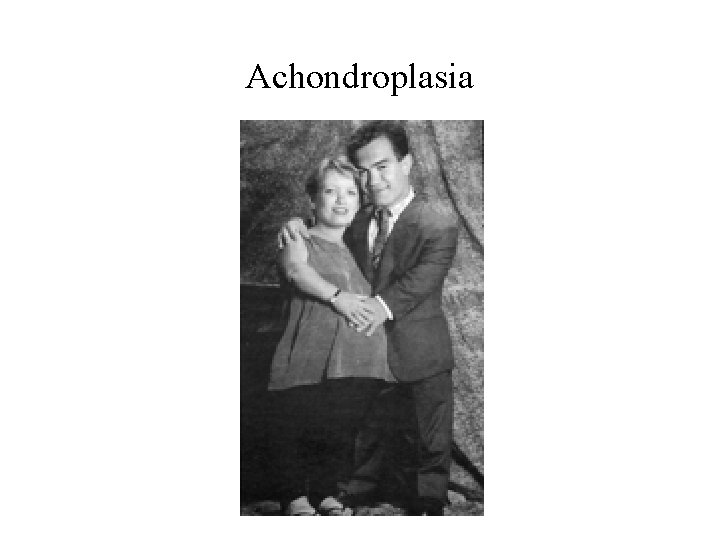Achondroplasia 