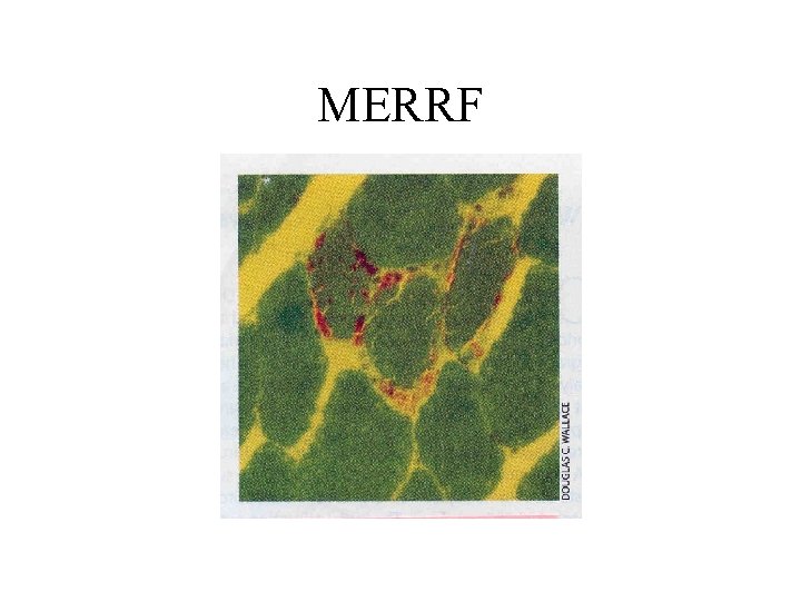 MERRF 