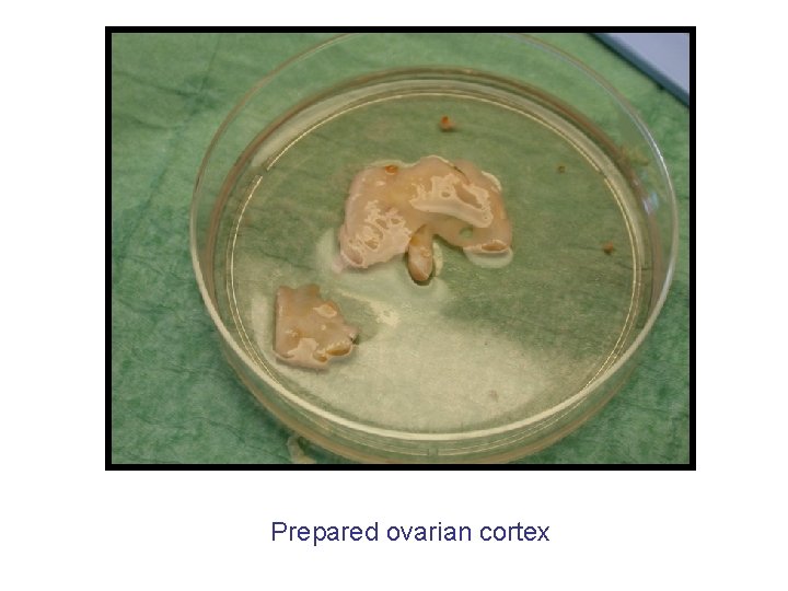 Prepared ovarian cortex 