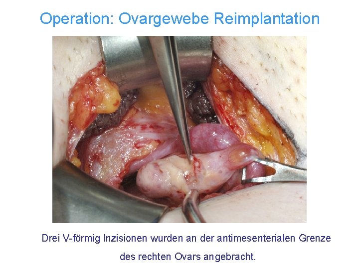 Operation: Ovargewebe Reimplantation Drei V-förmig Inzisionen wurden an der antimesenterialen Grenze des rechten Ovars