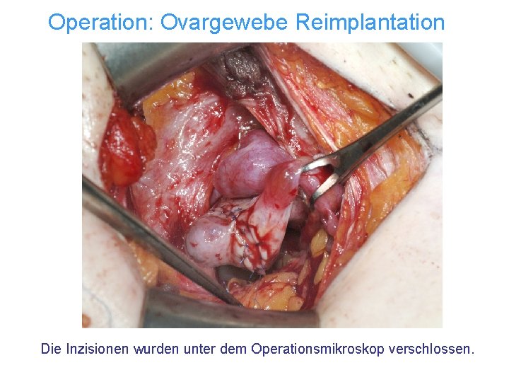 Operation: Ovargewebe Reimplantation Die Inzisionen wurden unter dem Operationsmikroskop verschlossen. 