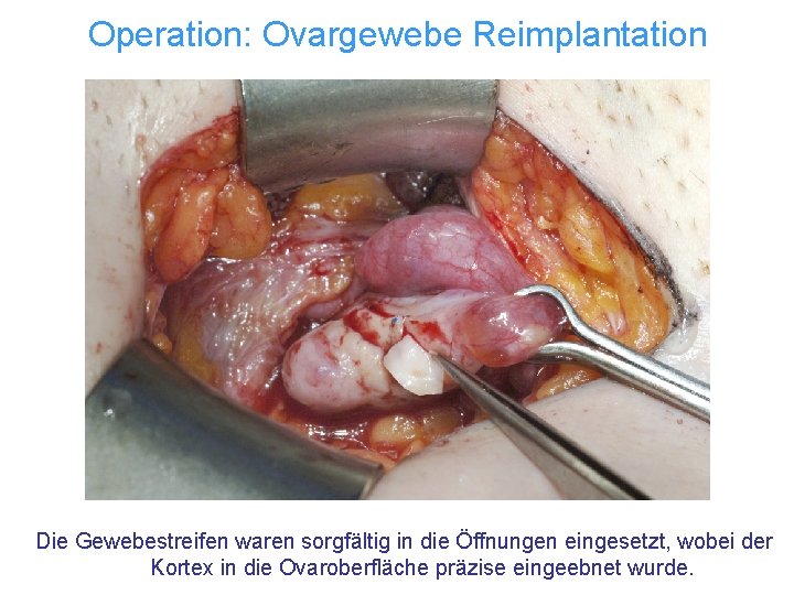 Operation: Ovargewebe Reimplantation Die Gewebestreifen waren sorgfältig in die Öffnungen eingesetzt, wobei der Kortex