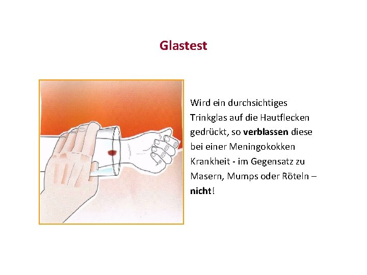 Glastest Wird ein durchsichtiges Trinkglas auf die Hautflecken gedrückt, so verblassen diese bei einer