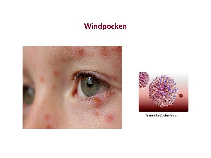 Windpocken Varicella-Zoster-Virus 