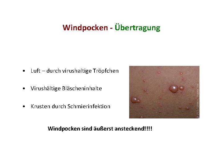 Windpocken - Übertragung • Luft – durch virushaltige Tröpfchen • Virushältige Bläscheninhalte • Krusten