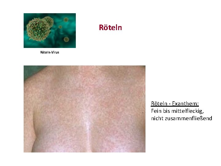 Röteln-Virus Röteln - Exanthem: Fein bis mittelfleckig, nicht zusammenfließend 