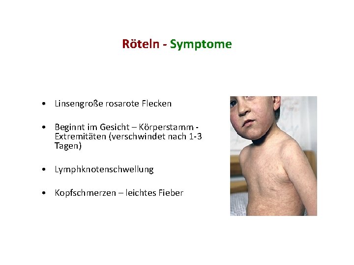 Röteln - Symptome • Linsengroße rosarote Flecken • Beginnt im Gesicht – Körperstamm Extremitäten