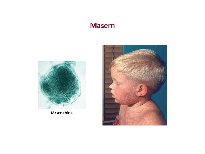 Masern-Virus 
