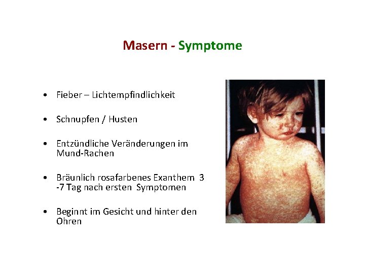 Masern - Symptome • Fieber – Lichtempfindlichkeit • Schnupfen / Husten • Entzündliche Veränderungen