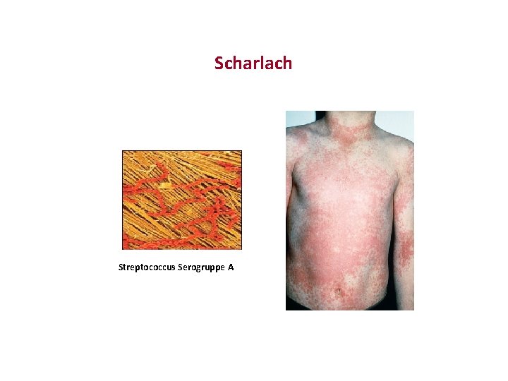 Scharlach Streptococcus Serogruppe A 