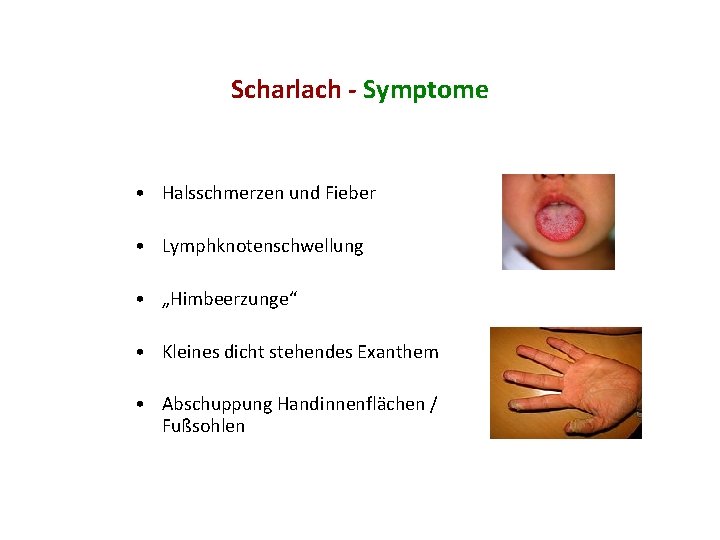 Scharlach - Symptome • Halsschmerzen und Fieber • Lymphknotenschwellung • „Himbeerzunge“ • Kleines dicht