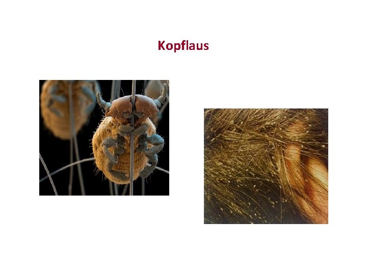 Kopflaus 