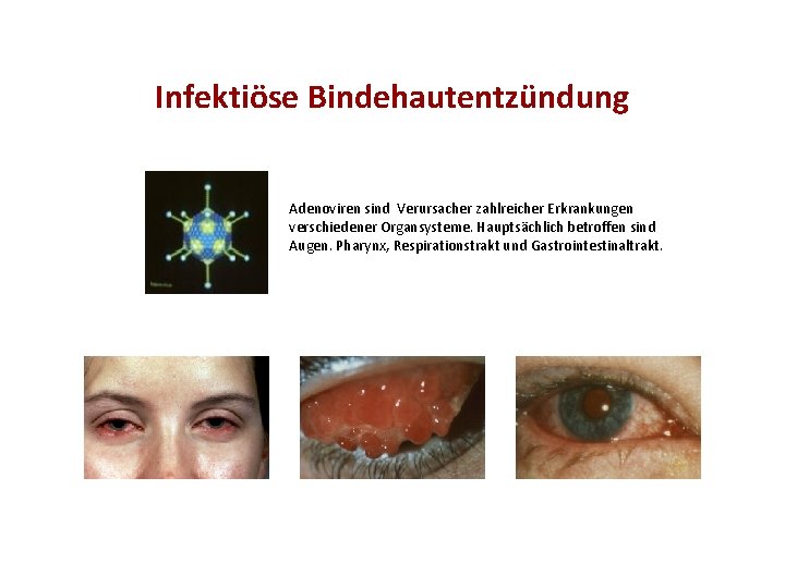 Infektiöse Bindehautentzündung Adenoviren sind Verursacher zahlreicher Erkrankungen verschiedener Organsysteme. Hauptsächlich betroffen sind Augen. Pharynx,