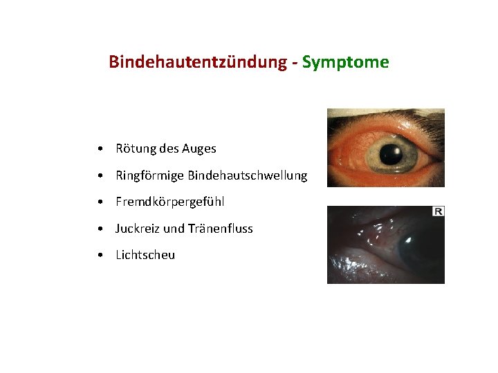 Bindehautentzündung - Symptome • Rötung des Auges • Ringförmige Bindehautschwellung • Fremdkörpergefühl • Juckreiz