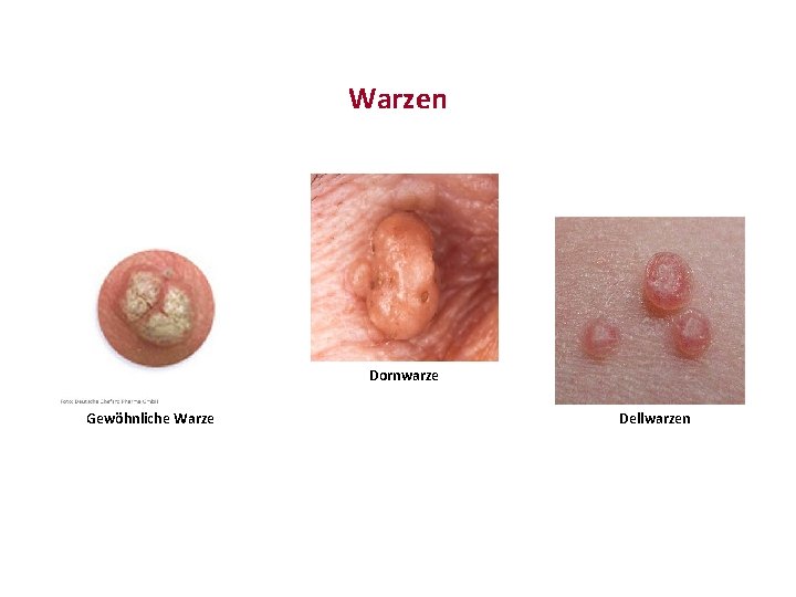 Warzen Dornwarze Gewöhnliche Warze Dellwarzen 