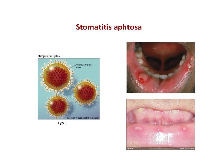 Stomatitis aphtosa Typ 1 