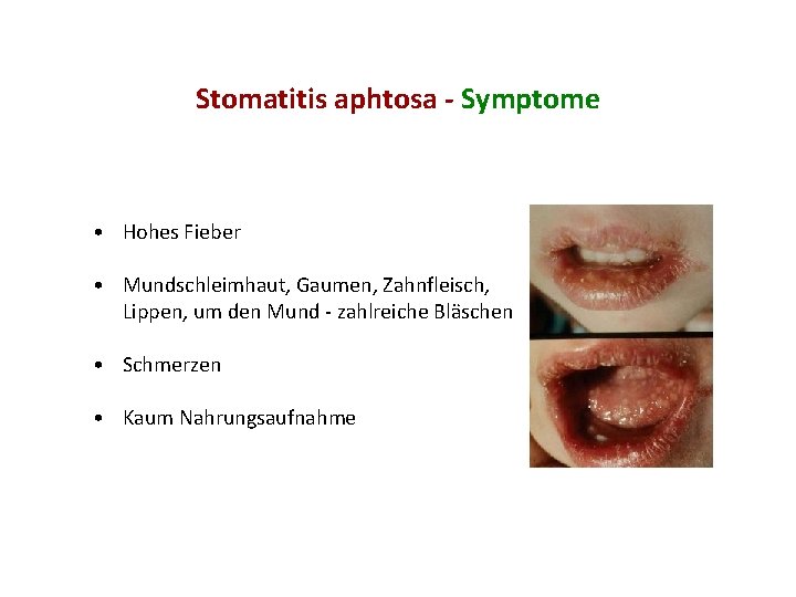 Stomatitis aphtosa - Symptome • Hohes Fieber • Mundschleimhaut, Gaumen, Zahnfleisch, Lippen, um den