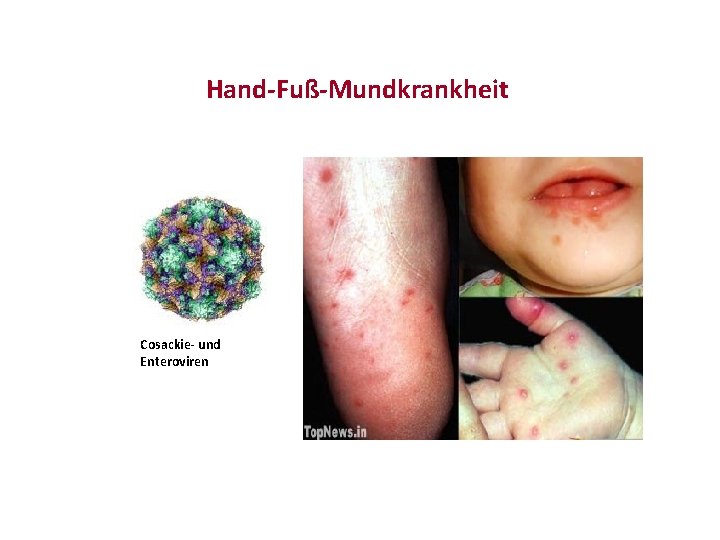 Hand-Fuß-Mundkrankheit Cosackie- und Enteroviren 