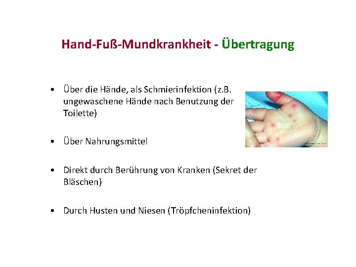 Hand-Fuß-Mundkrankheit - Übertragung • Über die Hände, als Schmierinfektion (z. B. ungewaschene Hände nach