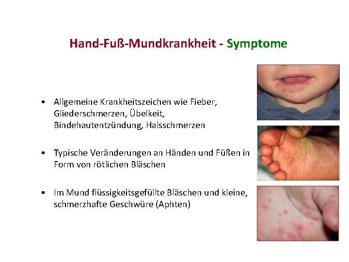 Hand-Fuß-Mundkrankheit - Symptome • Allgemeine Krankheitszeichen wie Fieber, Gliederschmerzen, Übelkeit, Bindehautentzündung, Halsschmerzen • Typische