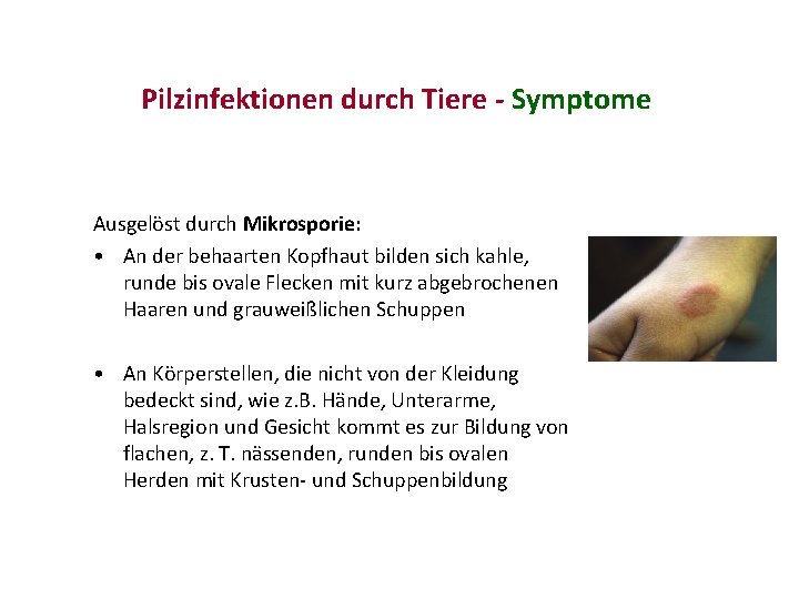 Pilzinfektionen durch Tiere - Symptome Ausgelöst durch Mikrosporie: • An der behaarten Kopfhaut bilden